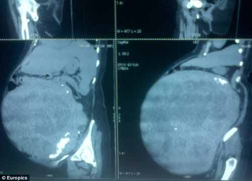 Cắt bỏ khối u khổng lồ nặng 15,6 kg khỏi bụng của người phụ nữ Cắt bỏ khối u khổng lồ nặng 15,6 kg khỏi bụng của người phụ nữ