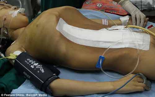 Phẫu thuật cắt bỏ thành công khối u nặng 15 kg cho một bé gái Phẫu thuật cắt bỏ thành công khối u nặng 15 kg cho một bé gái