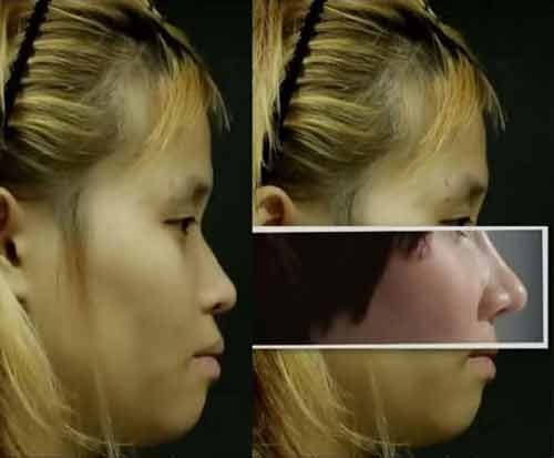 Phẫu thuật thẩm mỹ để nữ tính hơn vì quá nam tính