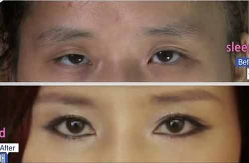 Phẫu thuật thẩm mỹ để nữ tính hơn vì quá nam tính