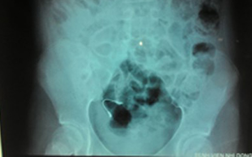 Ngủ dậy, phát hiện niềng răng lọt vào bụng bé 12 tuổi Ngủ dậy, phát hiện niềng răng lọt vào bụng bé 12 tuổi