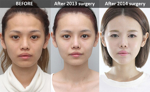 Hot blogger Singapore gây choáng vì khoe “chiến tích dao kéo”