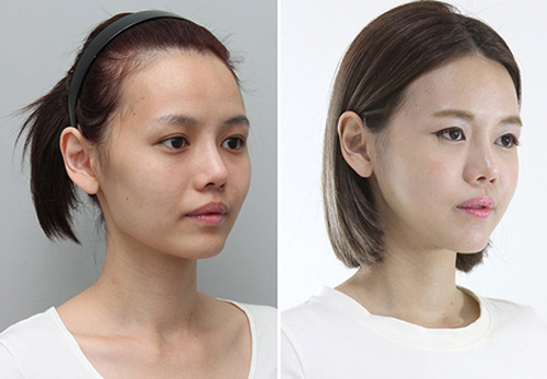 Hot blogger Singapore gây choáng vì khoe “chiến tích dao kéo”