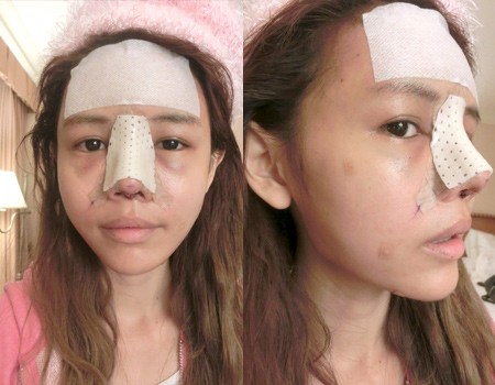Hot blogger Singapore gây choáng vì khoe “chiến tích dao kéo”