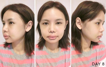 Hot blogger Singapore gây choáng vì khoe “chiến tích dao kéo”