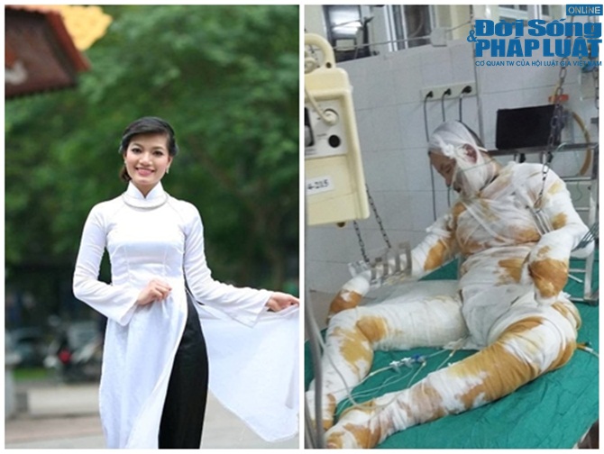 Xót thương cô gái bị bỏng nặng do cồn ở Thanh Hóa đã qua đời