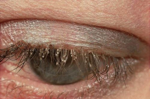 Rận mu tái xuất Rận mu tái xuất