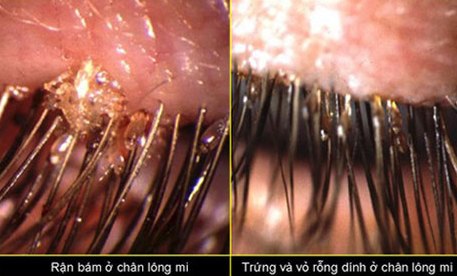 Rận mu: Xuất hiện một số trường hợp bị Rận bẹn ký sinh ở Hà Nội Rận mu: Xuất hiện một số trường hợp bị Rận bẹn ký sinh ở Hà Nội