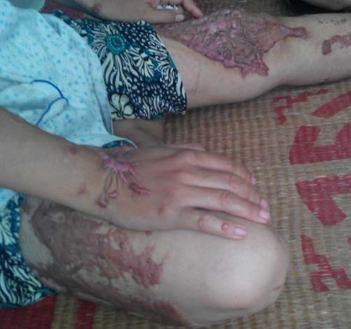 Lời kêu cứu xót xa của một nạn nhân bị tạt axit Lời kêu cứu xót xa của một nạn nhân bị tạt axit