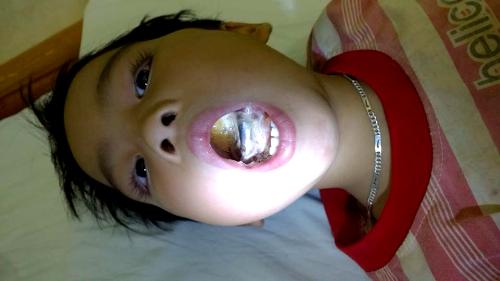 Bé 6 tuổi cháy lưỡi vì ngậm phích cắm điện