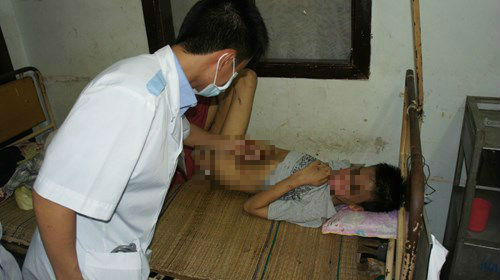 Bé khuyết tật bị đánh đập: Có dấu hiệu bị lạm dụng tình dục? Bé khuyết tật bị đánh đập: Có dấu hiệu bị lạm dụng tình dục?