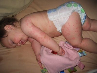 Triệu chứng và cách phòng chữa bệnh chân tay miệng ở trẻ em Triệu chứng và cách phòng chữa bệnh chân tay miệng ở trẻ em