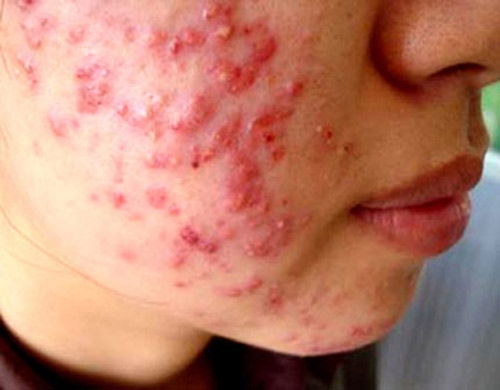 Rùng rợn trào lưu lột da như rắn để làm trắng