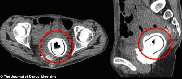 Đồ chơi tình dục: Không cẩn thận rước họa vào thân Đồ chơi tình dục: Không cẩn thận rước họa vào thân