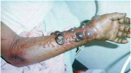 Những hình ảnh đáng sợ về dịch bệnh Ebola