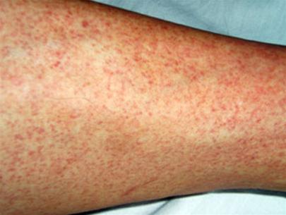 Những hình ảnh đáng sợ về dịch bệnh Ebola