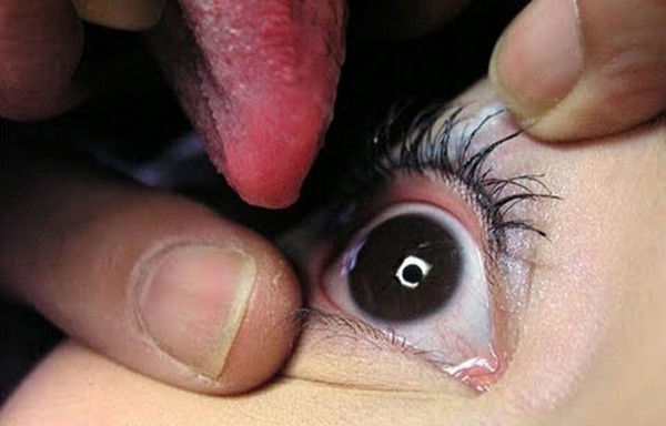 Cụ bà chữa bệnh bằng cách liếm vào nhãn cầu Cụ bà chữa bệnh bằng cách liếm vào nhãn cầu