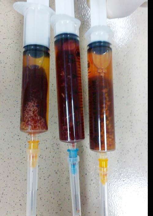 Ăn thịt bò tái, bé gái 4 tuổi bị nhiễm sán lá gan Ăn thịt bò tái, bé gái 4 tuổi bị nhiễm sán lá gan