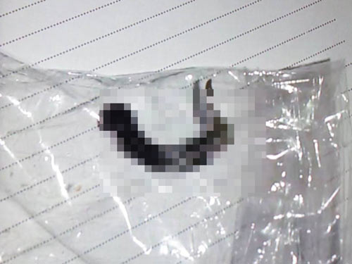 Đỉa sống ký sinh hơn 1 tháng trong thanh quản bé 11 tuổi