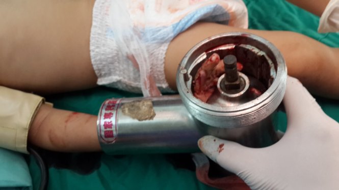 Tai nạn với máy xay thịt, bé 3 tuổi bị nát nhừ bàn tay Tai nạn với máy xay thịt, bé 3 tuổi bị nát nhừ bàn tay