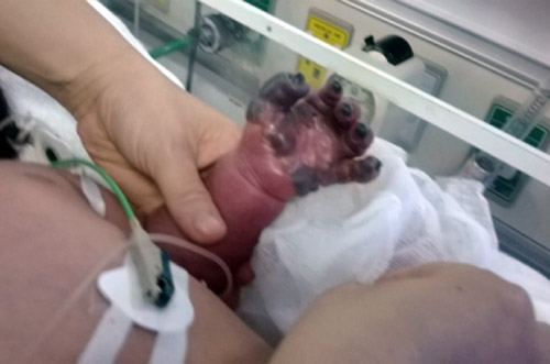 Bệnh nhi hoại tử cánh tay chết do nhiễm trùng máu?