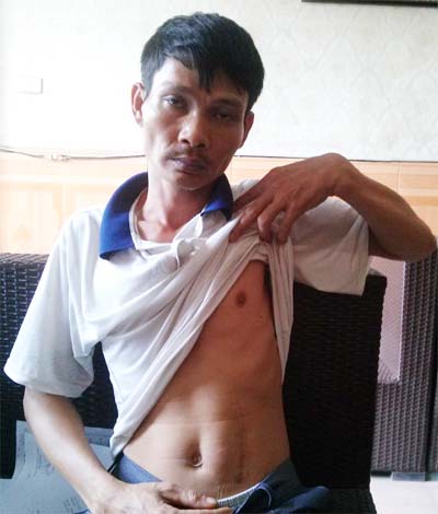 Bệnh nhân gần 2 năm “nuôi dị vật” do bác sỹ “để quên” sau ca mổ