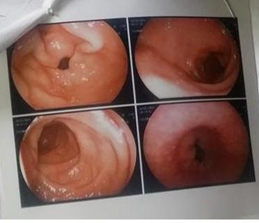 Khỏi viêm loét, loạn sản dạ dày sau gần 20 năm