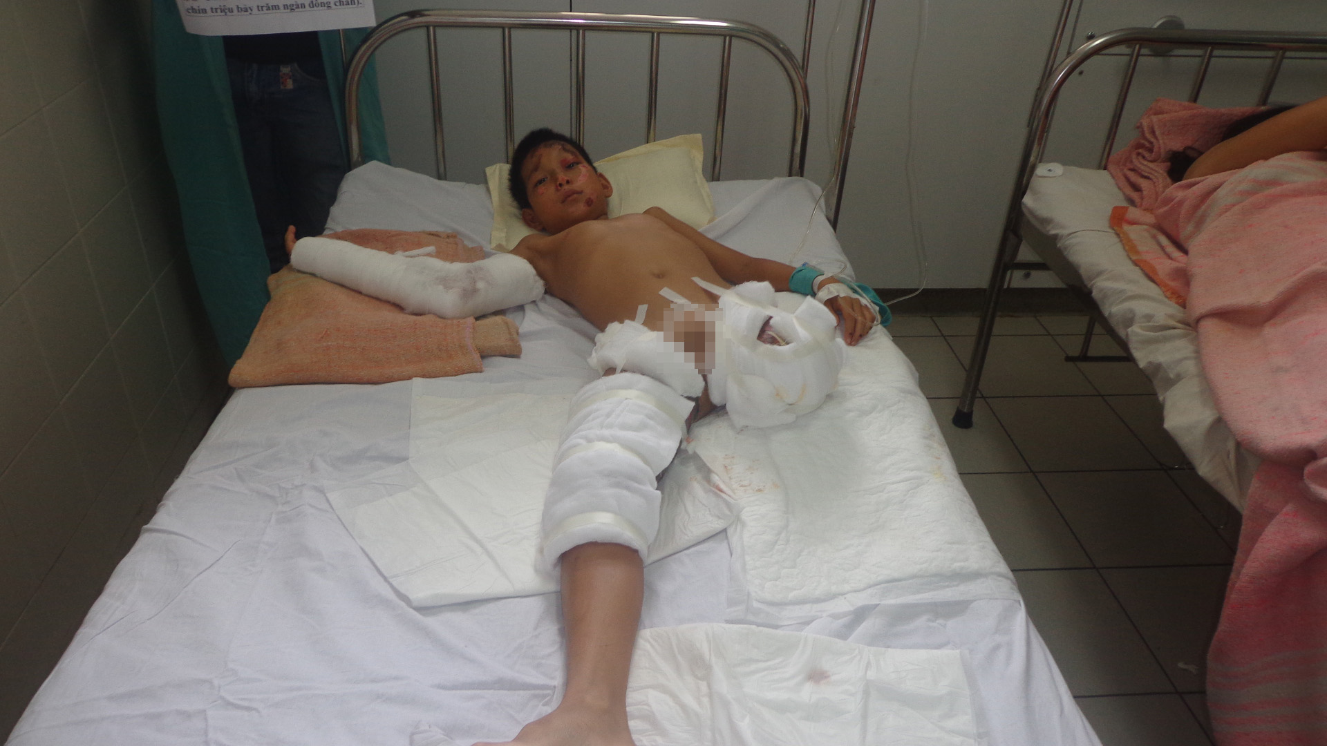 Thương tâm cậu bé mồ côi bị tai nạn phải cưa chân Thương tâm cậu bé mồ côi bị tai nạn phải cưa chân