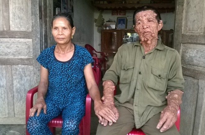 Hai mối tình của người đàn ông mang hàng ngàn khối u