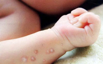 Bệnh-thủy-đậu-lành-tính-nhưng-mắc-rải-rác-dễ-lây-nhiễm