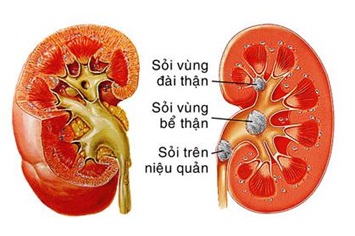 Triệu chứng và cách điều trị bệnh sỏi thận Triệu chứng và cách điều trị bệnh sỏi thận