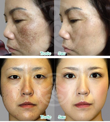 Làm sao để điều trị nám tận gốc?