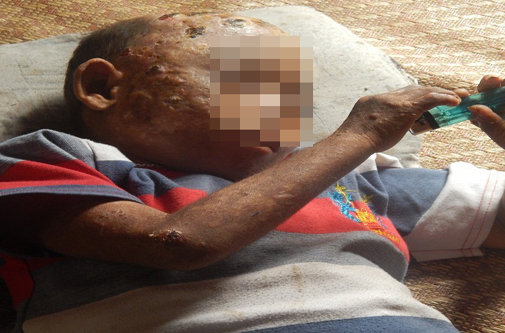 (bgiay)Cảm thương bé 7 tuổi mắc bệnh lạ phồng rộp toàn thân với v