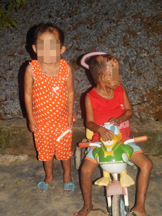 (bgiay)Cảm thương bé 7 tuổi mắc bệnh lạ phồng rộp toàn thân với v