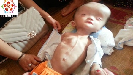 Người mẹ bán cả chó chữa bệnh cho con “dài cổ” đợi tiền từ thiện Người mẹ bán cả chó chữa bệnh cho con “dài cổ” đợi tiền từ thiện