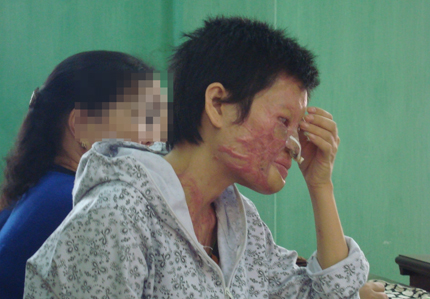 Cuộc đời khốn cùng của người đàn bà bị chồng tạt axít mù mắt