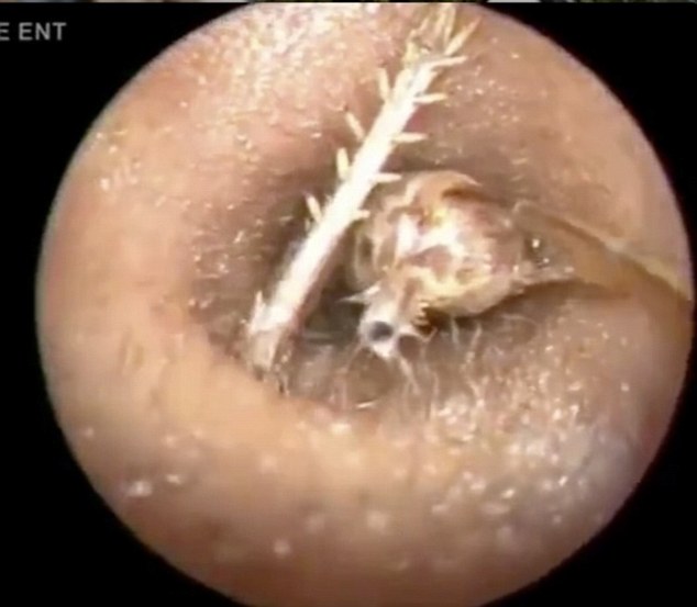 Kinh hãi khi phát hiện dế khổng lồ làm tổ trong tai người  