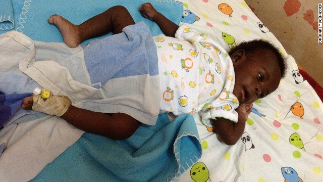 Cắt bỏ tứ chi của bé trai sinh ra có 4 chân 4 tay ở Uganda