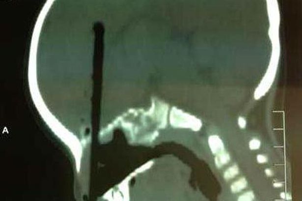 Trung Quốc: Bé trai 2 tuổi bị đũa chọc từ mũi lên não  