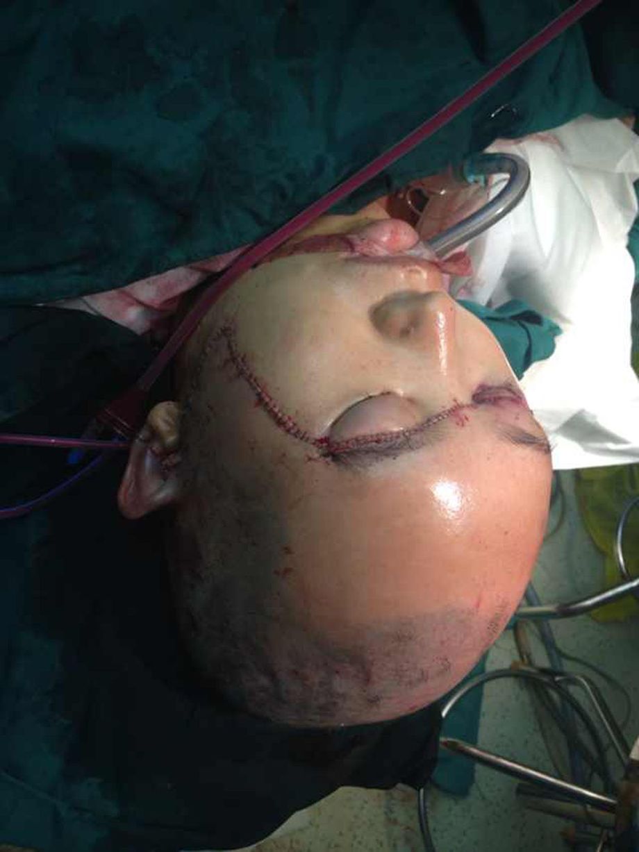 Người phụ nữ Trung Quốc bị lột da đầu vì máy nghiền thức ăn