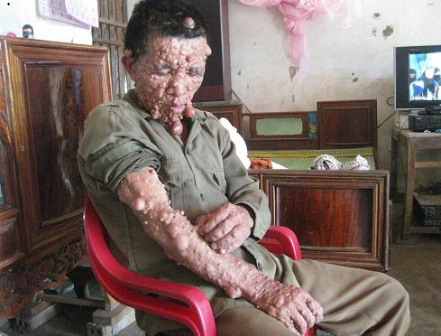 Xót thương người đàn ông mang thân hình ‘quỷ dữ’