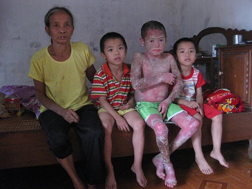 Gia đình nghèo có con mắc bệnh vảy nến thể mủ cần giúp đỡ