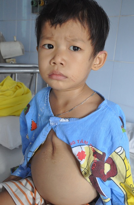 Không có tiền thay van tim, bé 3 tuổi nguy kịch từng ngày