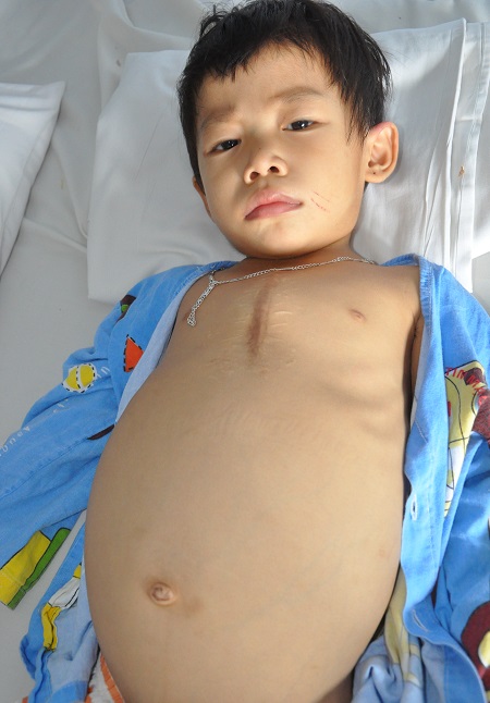 Không có tiền thay van tim, bé 3 tuổi nguy kịch từng ngày