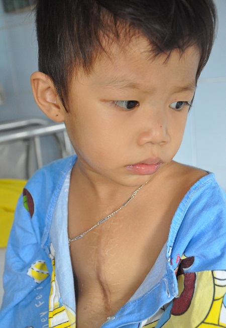 Không có tiền thay van tim, bé 3 tuổi nguy kịch từng ngày