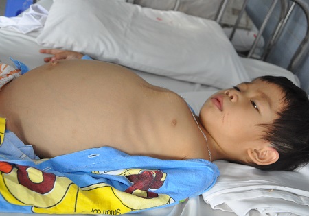 Không có tiền thay van tim, bé 3 tuổi nguy kịch từng ngày