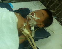 Bé trai 6 tuổi vỡ lá lách được cứu sống sau cú ngã lan can