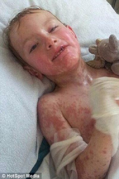 Hình ảnh đau lòng của em bé bị dị ứng thuốc Hình ảnh đau lòng của em bé bị dị ứng thuốc