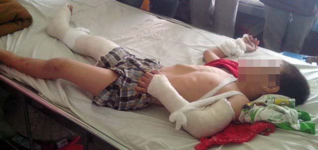 Bé trai 6 tuổi bị cha dượng đánh: Bị đánh cả ngày