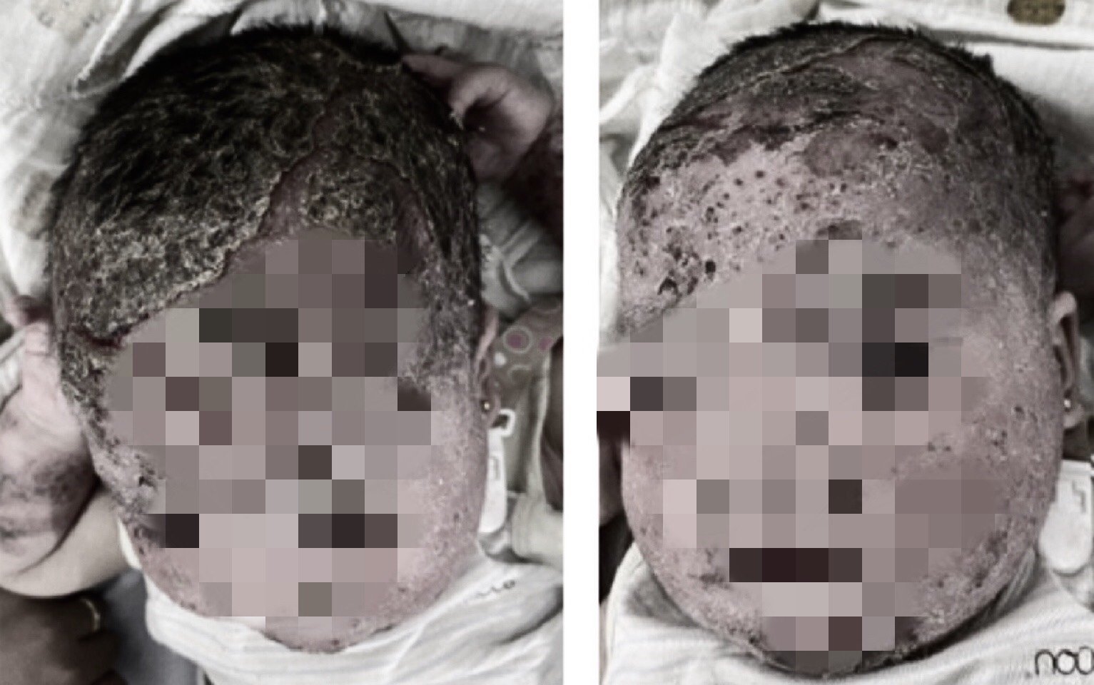 tam nhieu loai la be trai 8 thang tuoi bi nut da dau bong troc khap mat 3 tam nhieu loai la be trai 8 thang tuoi bi nut da dau bong troc khap mat 3